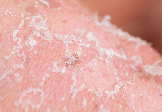 textured background with scales of dead skin cells covered with cracks after sunburn break off from the body
