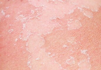 texture of irritated reddened skin with flaking scales of dead old cells after sunburn and allergies on the human body