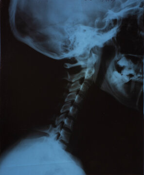 X-ray photo of the neck area of an adult.