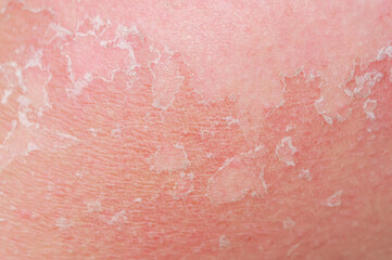 background with the texture of irritated reddened skin with flaking scales and cracks from sunburn and allergies on the human body