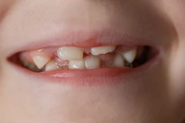 Fotobehang Baby& 39 s mond met tanden. Close-up portret van 6 jaar oud meisje zonder melktanden. © Albert Ziganshin