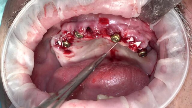 gingival formers after the implantation operation on the upper jaw of the patient and suturing of the gums with absorbable dental material