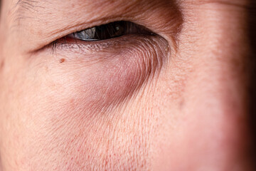 Obraz premium Men eye with wrinkle and mole .skin aging problem.