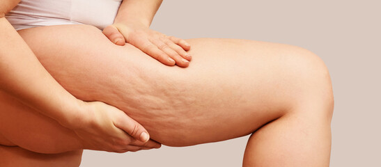 Cellulite leg woman pinch. Test fat hips treatment. Over weight liposuction. Remove striae. - obrazy, fototapety, plakaty