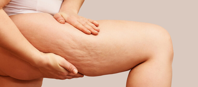Cellulite leg woman pinch. Test fat hips treatment. Over weight liposuction. Remove striae.