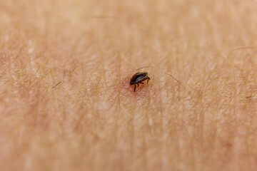 Tick bitten in human skin 7