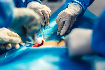 Professional anesthesiologist doctor medical team and assistant preparing patient to gynecological...