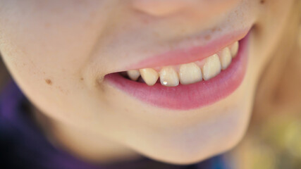 Young girl smiling with a diamond on a tooth. Skyce on the teeth. Dental diamond piercing.