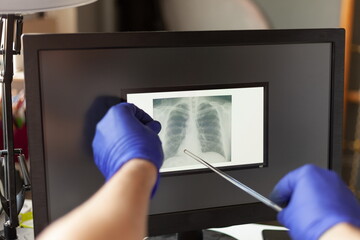 doctors hands in medical gloves hold an x ray picture of a persons lungs near a computer screen