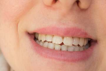  natural shade teeth, natural healthy teeth close-up. female smile