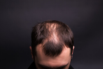 Male head close-up with baldness. Studio black background.