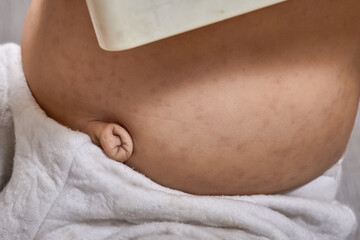 the child has a rash, a long umbilical cord, dark pigmented spots