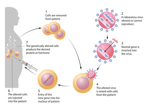 Gene therapy is the insertion of genes into an individual's cells and tissues to treat a disease