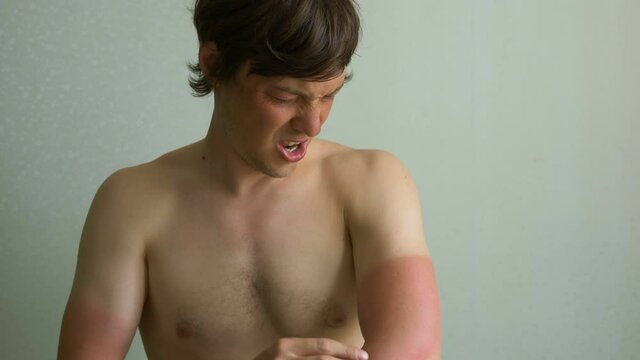 young man with pain touches the burned skin of his hands, sunburn without protection