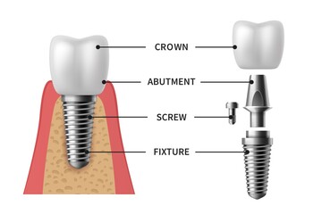 Tooth implant. Realistic implant structure pictorial models crown. Abutment, screw denture orthodontic implantation teeth vector set - obrazy, fototapety, plakaty