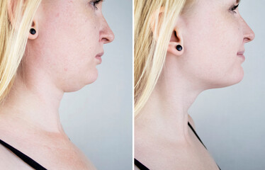 Second chin lift in women. Photos before and after plastic surgery, mentoplasty or facebuilding....