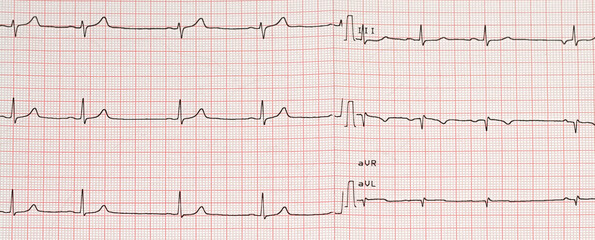 Electrocardiogram example of a normal 12-lead sinus rhythm