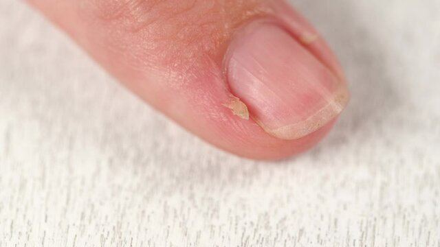 Closeup view 4k video footage of  female hand with bad long dirty nails and dry painful skin cuticle. One finger of adult woman isolated on white background. Ugly long hangnail.