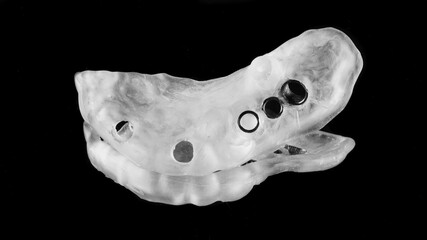 dental template with titanium sleeves for implantation of three implants in the end part