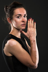 Vitiligo on the hands. Young beautiful woman with vitiligo.