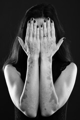 Vitiligo on the hands. Young beautiful woman with vitiligo.