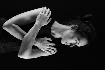 Vitiligo on the hands. Young beautiful woman with vitiligo.