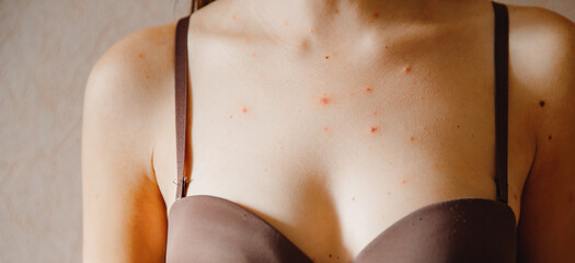 Close-up skin of adult woman affected by chickenpox, acne and dermatology