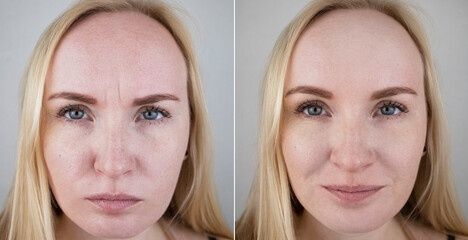 Photos before and after mesotherapy, biorevitalization, botulinum toxin injections. Skin fold...