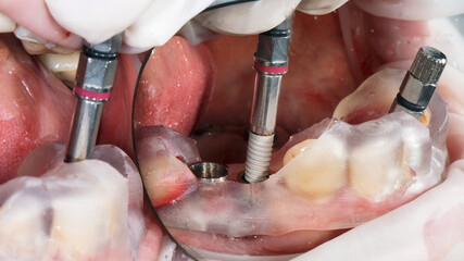 Implantation of a high-quality implant through a surgical template for high precision integration...
