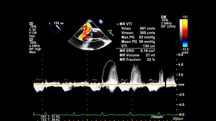 Image of the heart during transesophageal ultrasound with Doppler mode.