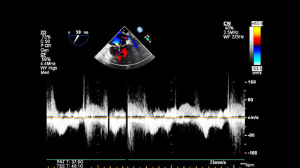Image of the heart during transesophageal ultrasound with Doppler mode.
