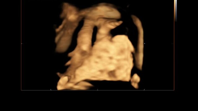 3D ultrasound echography of fourth month fetus