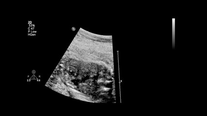 Ultrasound screen with fetal echocardiography