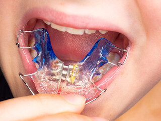 Patient photo of teeth with orthodontic braces. - 359883777