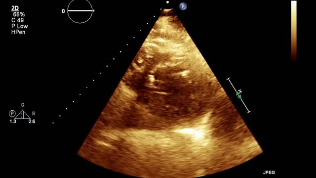 Transesophageal ultrasound video in gray-scale mode.