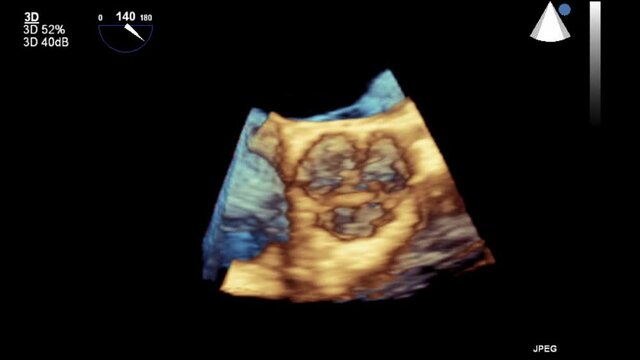 Transesophageal ultrasound video in 3D mode.
