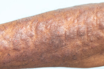 A physical of Atopic dermatitis (AD), also known as atopic eczema, is a type of inflammation of the skin (dermatitis).
