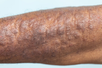 A physical of Atopic dermatitis (AD), also known as atopic eczema, is a type of inflammation of the skin (dermatitis).
