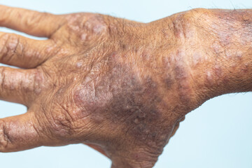 A physical of Atopic dermatitis (AD), also known as atopic eczema, is a type of inflammation of the skin (dermatitis).
