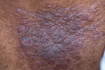 Naklejka premium A physical of Atopic dermatitis (AD), also known as atopic eczema, is a type of inflammation of the skin (dermatitis). 
