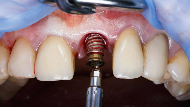 reimplantation dental implant due to complications after surgery