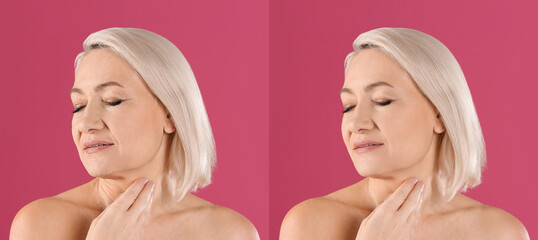 Mature woman before and after cosmetic procedure on pink background