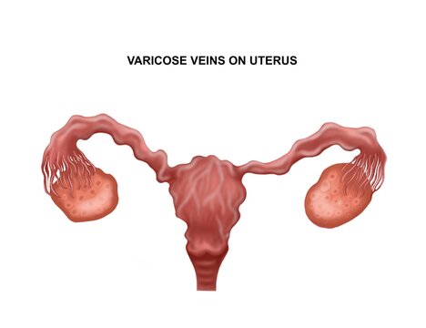 Medical illustration of the varicose veins on uterus