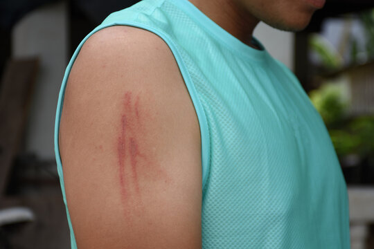 Close up of painful wounds on handsome man is shoulder after bitten by Paederus dermatiti or Rove beetles bite him. He has a burning pain at skin
