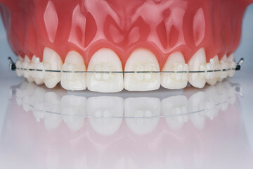 dental phantom model with upper jaw braces for demonstration to patients, shot on a white background with reflection © Dental Pro Content