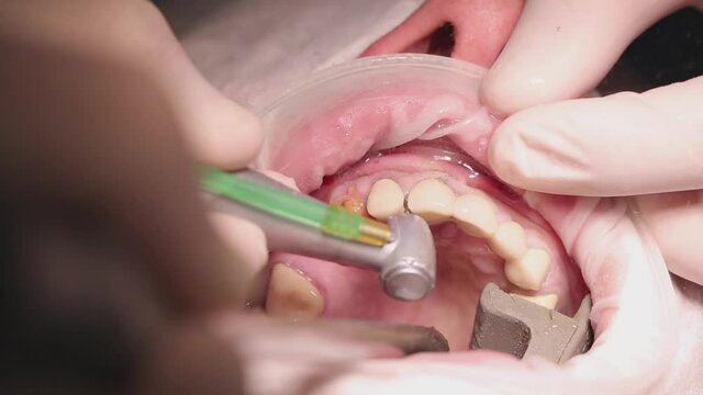 preparation of the preparation of teeth of old crowns of the upper jaw to remove