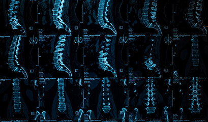 MRI scans of the lumbosacral spine. MRI shows degenerative changes in the spine, hernia of the...