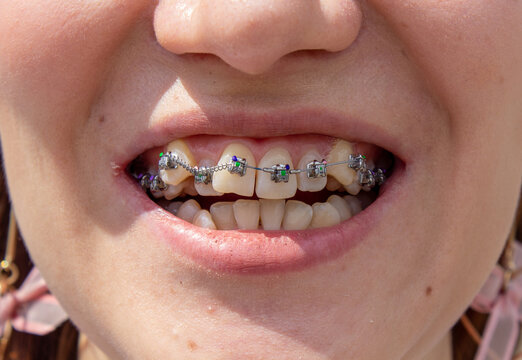 Braces on the upper jaw are located close, you can see that the teeth grow crooked and need braces to align the teeth.