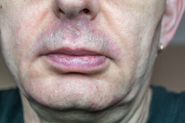 dettaglio del viso dell'uomo con dermatite seborroica