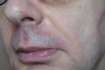 Fototapeta premium Fragment górnej wargi mężczyzny z łojotokowym zapaleniem skóry